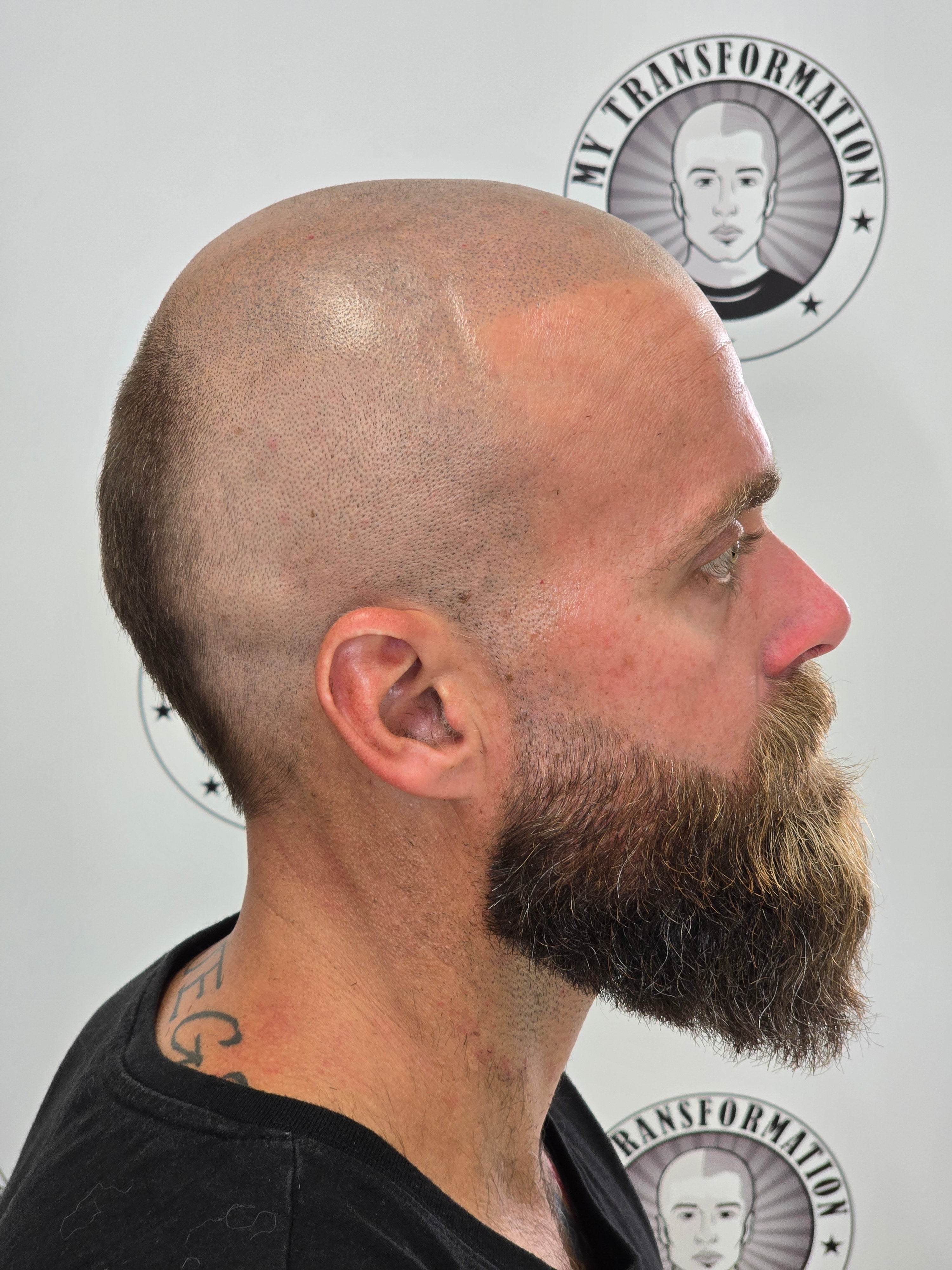 My Transformation, Scalp Micropigmentation Perth, Hair Tattoo Perth, SMP Perth, SMP WA, Perth Australia, Men's hair Tattoo