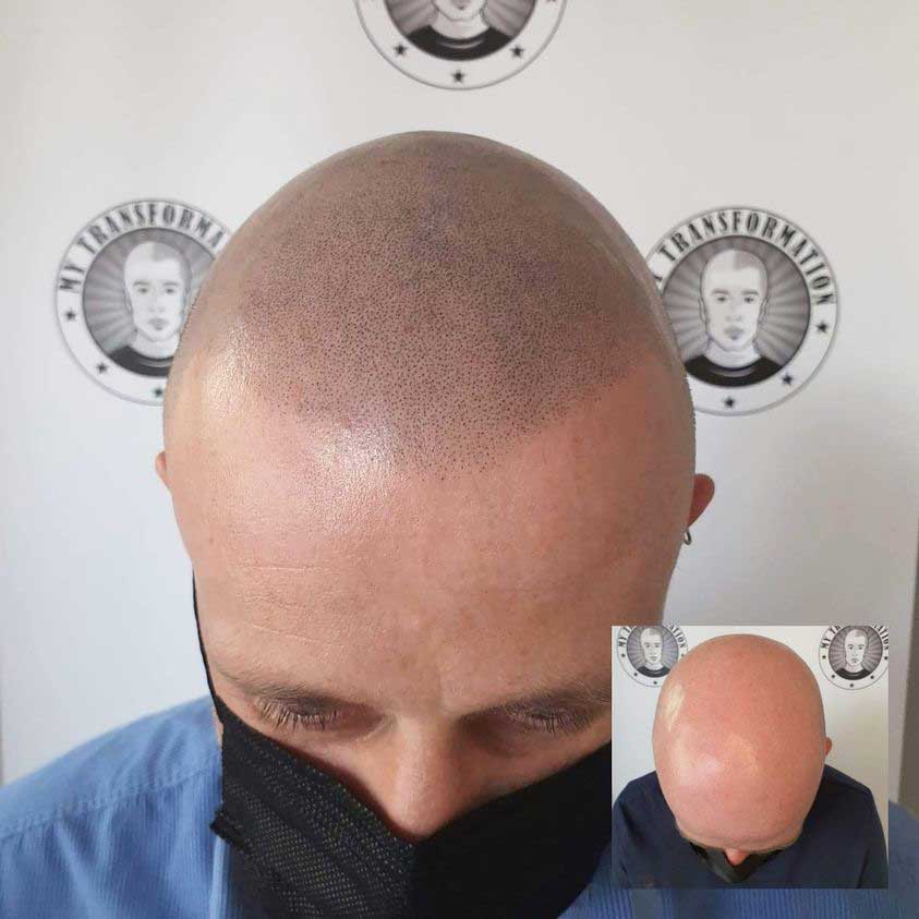 My Transformation, Scalp Micropigmentation Perth, Hair Tattoo Perth, MP Perth, SMP WA, Perth Australia