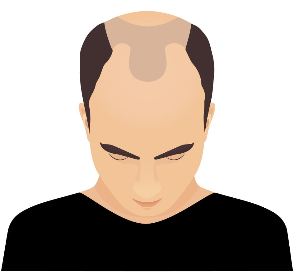 Balding solution for men - Add density to thinning areas for the appearance of thick strong hair for men and women.