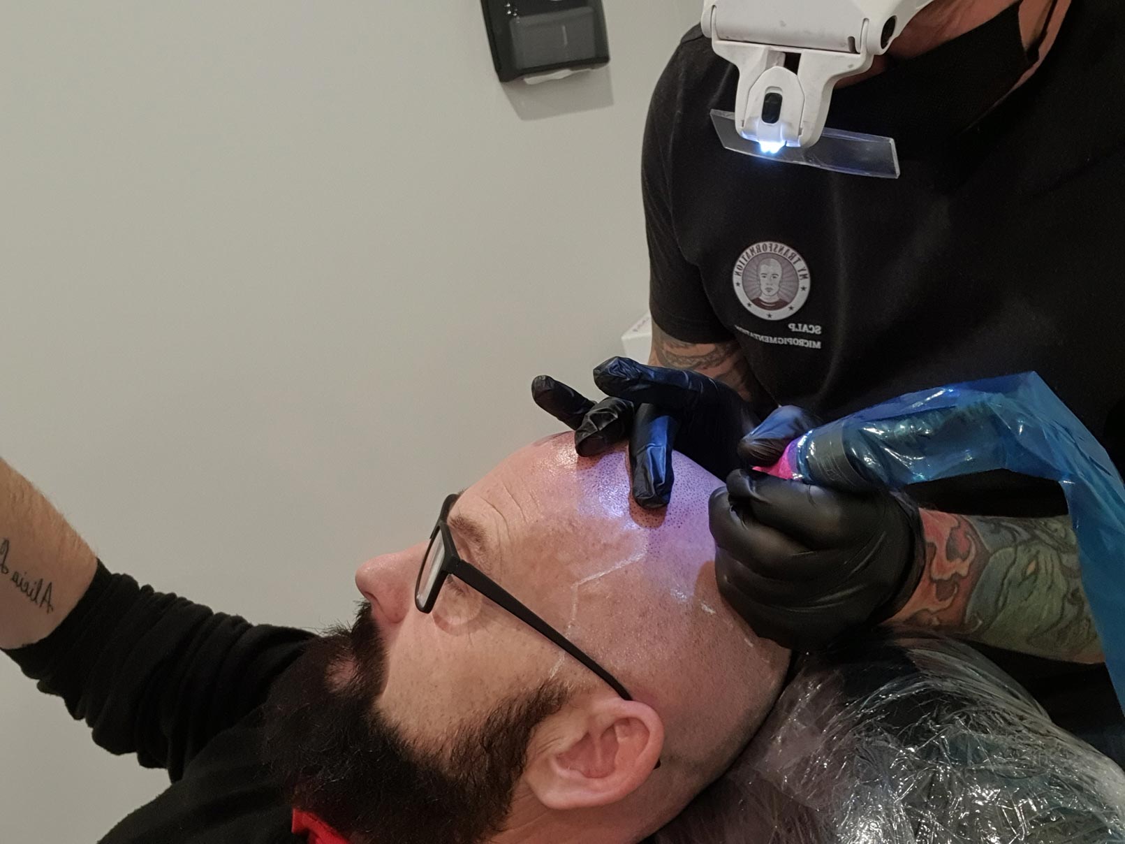 Scalp Micrpigmentation / Hair Tattoo for men & women. Perth,WAAustralia