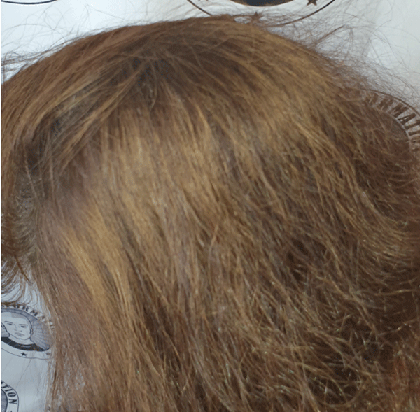 adding-scalp-micropigmentation-density-to-a-lady.