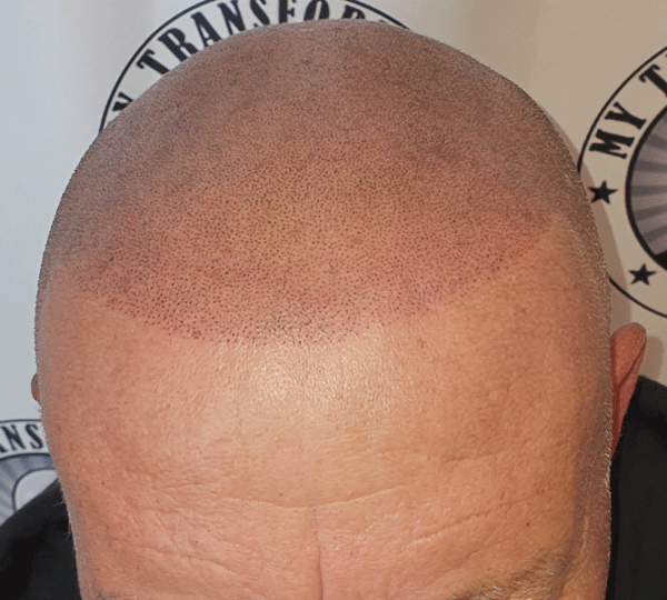 client-front-view-scalp-micrpigmentation