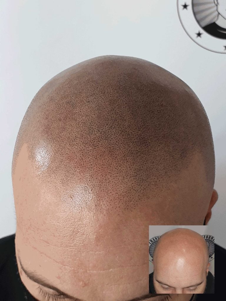 scalp-micropigmentation-before-and-after