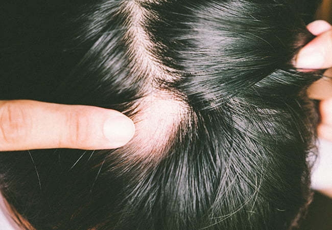 Treat alopecia with SMP