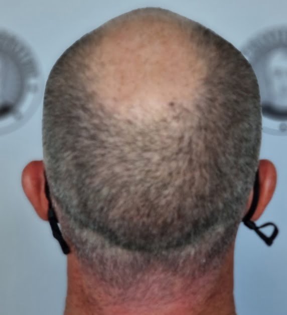 Before-scalp-micropigmentation.