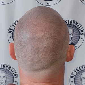 SMP - Scalp Micropigmentation Results Gallery | My Transformation